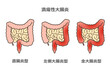 潰瘍性大腸炎直腸型