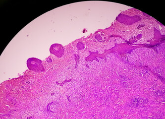 Poster - Skin biopsy : Suggestive of Basal cell carcinoma, the most common type of skin cancer.