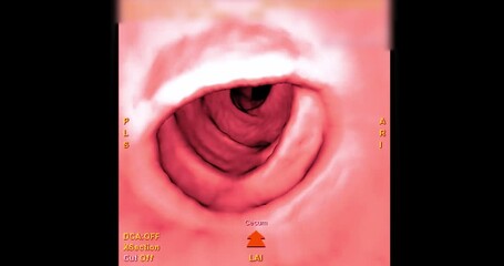 Sticker - CT colonography or CT Scan of large intestine 3D rendering  on the screen for diagnosis large bowel cancer or colon cancer and colorectal cancer.