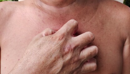 Portrait showing dryness skin infections, allergic reactions and rash on the body, problem dark spots and rough skin, scratch itchy of the male patient, concept health care.