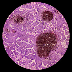 Canvas Print - Skin biopsy, Scalp carcinoma, pigmented basal cell carcinoma, the most common type of sun induced skin cancer.