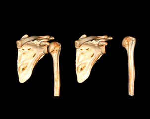 Poster - CT scan of shoulder joint.