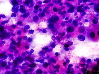 Wall Mural - Spindle Cell Sarcoma: an extremely rare bone cancer. Photomicrograph of soft tissue tumor cytology.