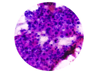 Poster - Spindle Cell Sarcoma: an extremely rare bone cancer. Photomicrograph of soft tissue tumor cytology.