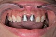 © MSC - Two metallic post and core reconstructions cemented in the central incisal tooth. Front view of mouth maxillary arch, retracted lips with cheek retractor. Composite poorly restored lateral incisors.