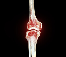 Poster - ct knee 3d rendering image