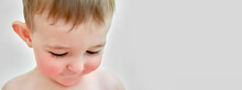 Portrait Of A Child With Allergies On The Cheeks And Chin. Toddler Baby Boy With Allergies On Red Face Skin, Copy Space