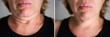 Leinwandbild Motiv Double Chin Face Plastic Surgery