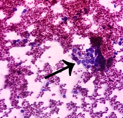 Cytological study of knee joint swelling: Spindle cell neoplasm, smear show cellular material of oval to spindle shaped cells, mild pleomorphism, blood.