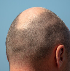 bald patch on a man's head against a sky.