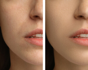 Wall Mural - Collage with photos of woman having dry skin problem before and after moisturizing, closeup