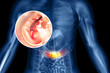 Colon cancer. colonoscope in the colon. polyp removal. 3d illustration