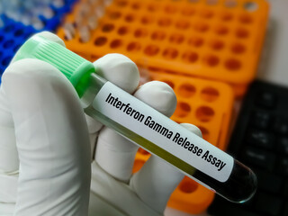 Wall Mural - Blood sample for Interferon Gamma Release Assay (IGRA) test for diagnosis of Tuberculosis