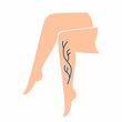 Vector illustration of legs with varicose veins. Sore feet.