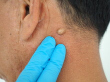 Man Pointed To Sebaceous Cysts On His Neck, Formed By Sebaceous Glands. Oils Called Sebum And Laser Skin Treatments Or Flea Biopsies Health Concept. Closeup Photo, Blurred.