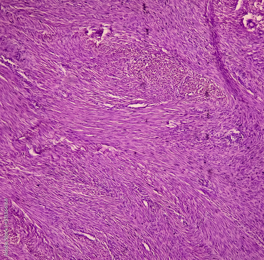 Uterus biopsy: Chronic cervicitis, proliferative phase, leiomyoma ...