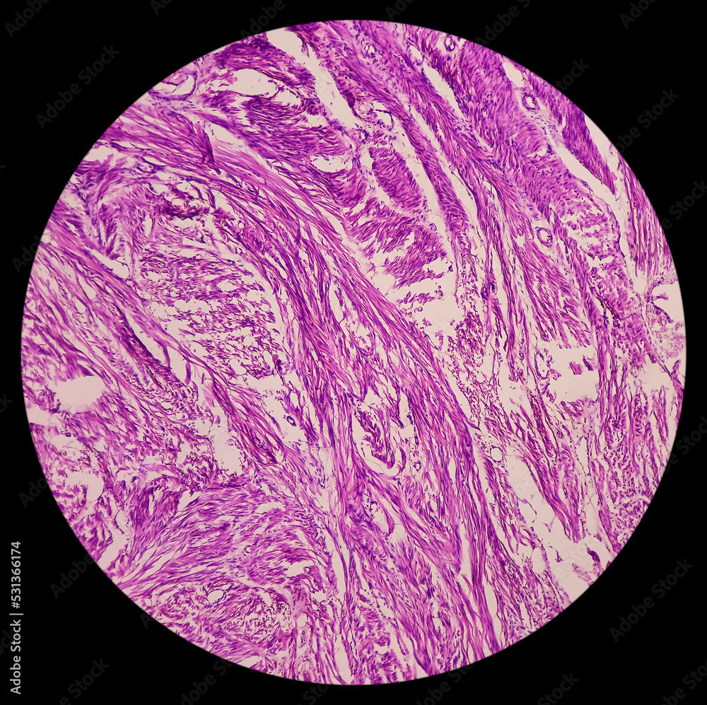Uterus biopsy: Chronic cervicitis, proliferative phase, leiomyoma ...