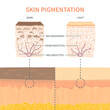 Comparison of melanosomes distribution in dark and light skin. Pigmentation mechanism in different phototypes. Close up of epidermis cross-section. Infographic medical diagram. Vector illustration.