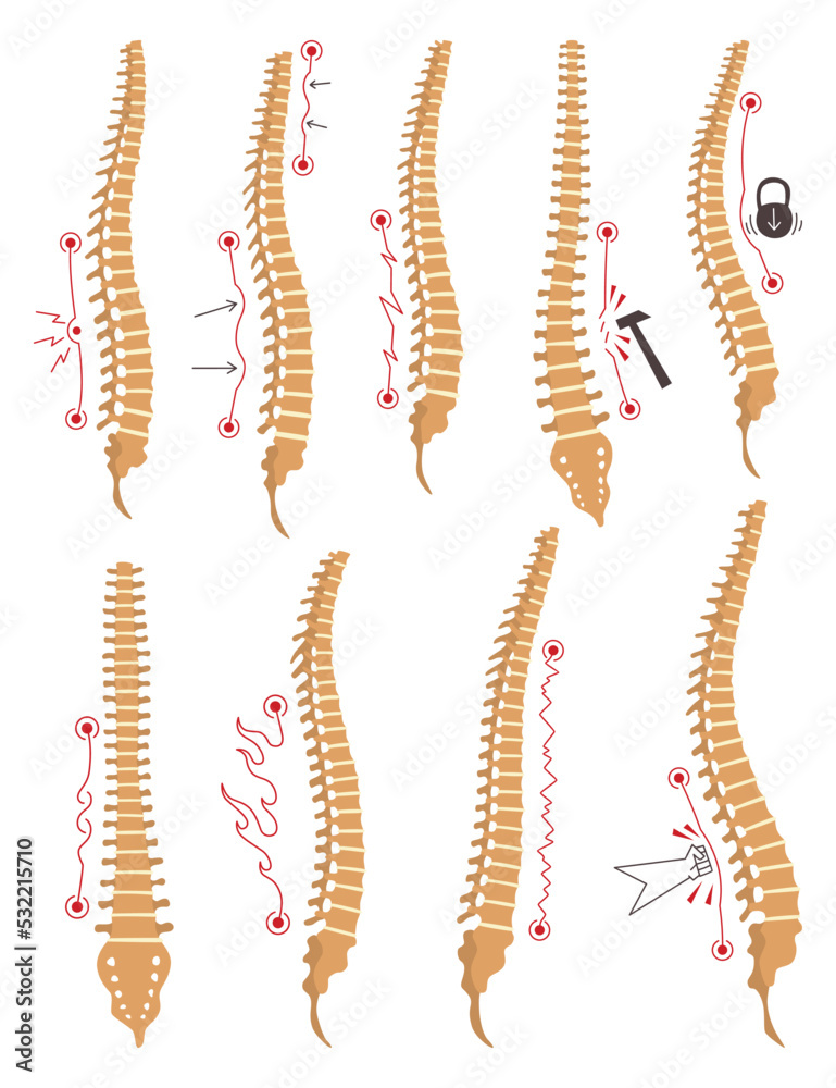 Spinal deformity types. Symbols of spine curvatures or unhealthy ...