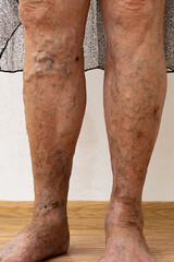 Vertical unrecognizable senior woman bare legs with protruding varix, spider varicose veins medical condition. Edema skin dermatology and health care. Cosmetology beauty treatment of vascular stars