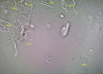 Sticker - Microscopic image of abnormal urinalysis. urine exam. Urine routine examination.