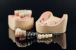 Composition of dental crowns and orthopedic components on a black background