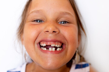 Wall Mural - Toothless smiling, glad, mischievous little blonde girl show baby temporary milk teeth on white view. Crooked teeth, bad dental occlusion. Hygiene problem. Orthodontic and stomatology work, medicine