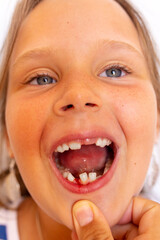 Wall Mural - Vertical little girl with open toothless mouth with crooked teeth and fresh wound bleeding gingiva. Stomatological appointment, dentist hand examining temporary milk teeth condition. Teeth loss