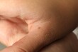 Closeup view of woman's hand with birthmark