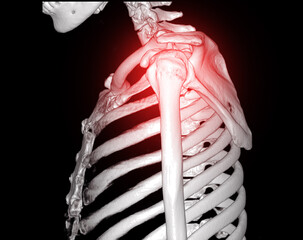 Poster - CT Shoulder 3D