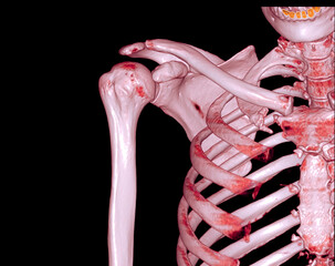 Poster - CT Shoulder 3D