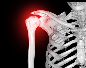 Poster - CT Shoulder 3D