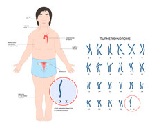 Turner And Fragile Syndrome Of The X Chromosomal Abnormality Test Genetic With Gonadal Dysgenesis Disorder In Female