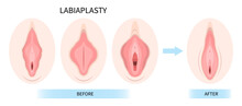 Female Women Genital Of Minor Vulval Labia Loose Lips Beauty Surgery To Tighten Hood Dry Vagina Disease And Posterior Colporrhaphy Reconstruction Male By The Vulvoplasty Dyspareunia Pain Menopause