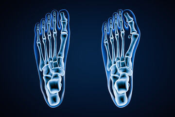 Wall Mural - hallux valgus or bunion x-ray 3d rendering illustration. dorsal or top view of human healthy and inj