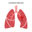Pulmonary embolism disease