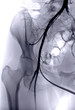 Femoral Angiogram of femoral artery.