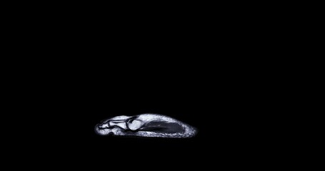 Poster - MRI foot scan for a diagnostic tool used to image the structures of the foot and ankle following symptoms: pain  both feet, swelling, redness or warmth, numbness or tingling and stiffness.