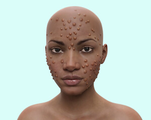 Poster - Patient with monkeypox, 3D illustration