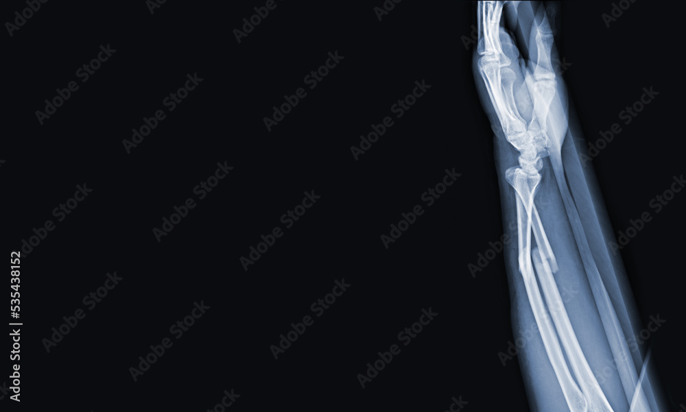 x-ray images of the both hand and wrist joint to see injuries radius ...