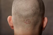 © Barta - Eczema caucasian male head back