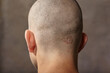 © Barta - Eczema caucasian male head back