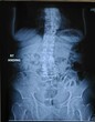 Back view of  X-ray film's image show degenerative back bone in old woman.