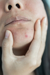 Wall Mural - Portrait of ugly teenage girl having problems of acne inflammation on her face. concept of facial care products. closeup photo, blurred.