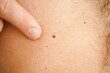 A red birthmark on a human body.