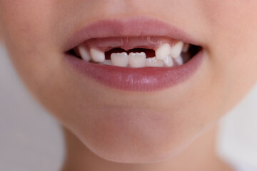 Wall Mural - Close-up of a child's mouth without milk front teeth.