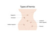 Types of hernia. Epigastric, incisional, direct inguinal, indirect inguinal, umbilical, femoral hernias.