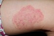 Fungal infection called tinea corporis in thigh of Asian child. Ringworm