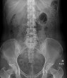 film x-ray woman abdomen