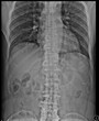 Scoliosis film x-ray lumbar spine